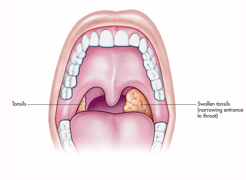 Understanding and Managing Swollen Tonsils: Causes and Home Remedies