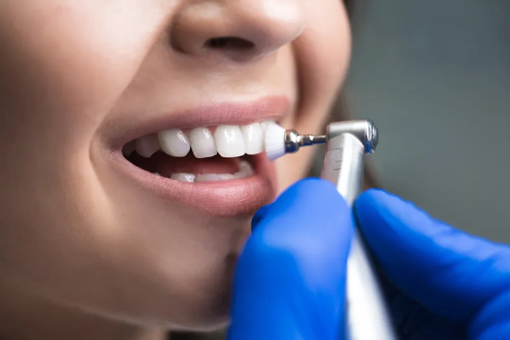 teeth scaling and polishing